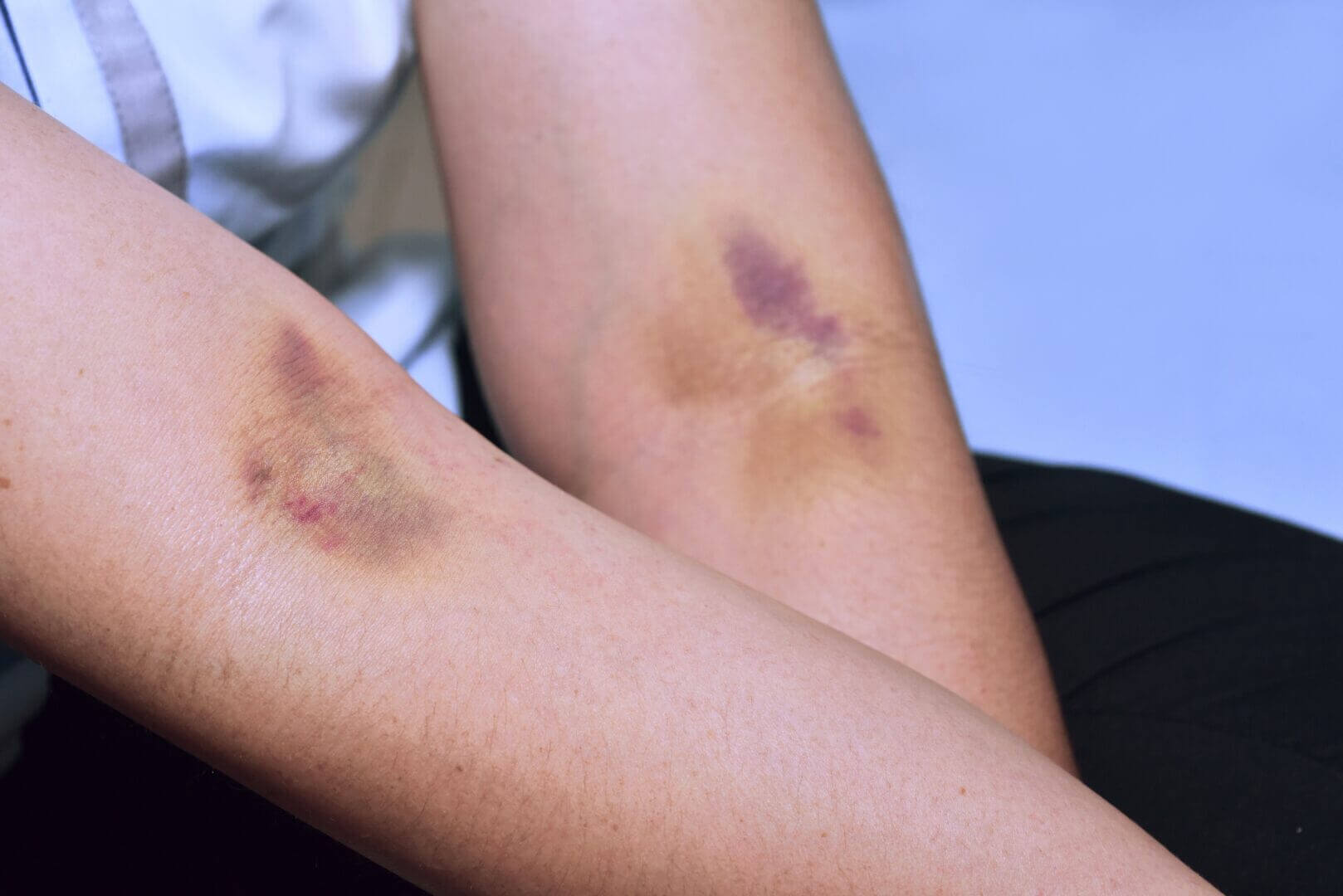 Homeopathic Bruise and Scar Cream image 2